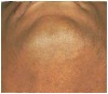 permanent-hair-reduction-4